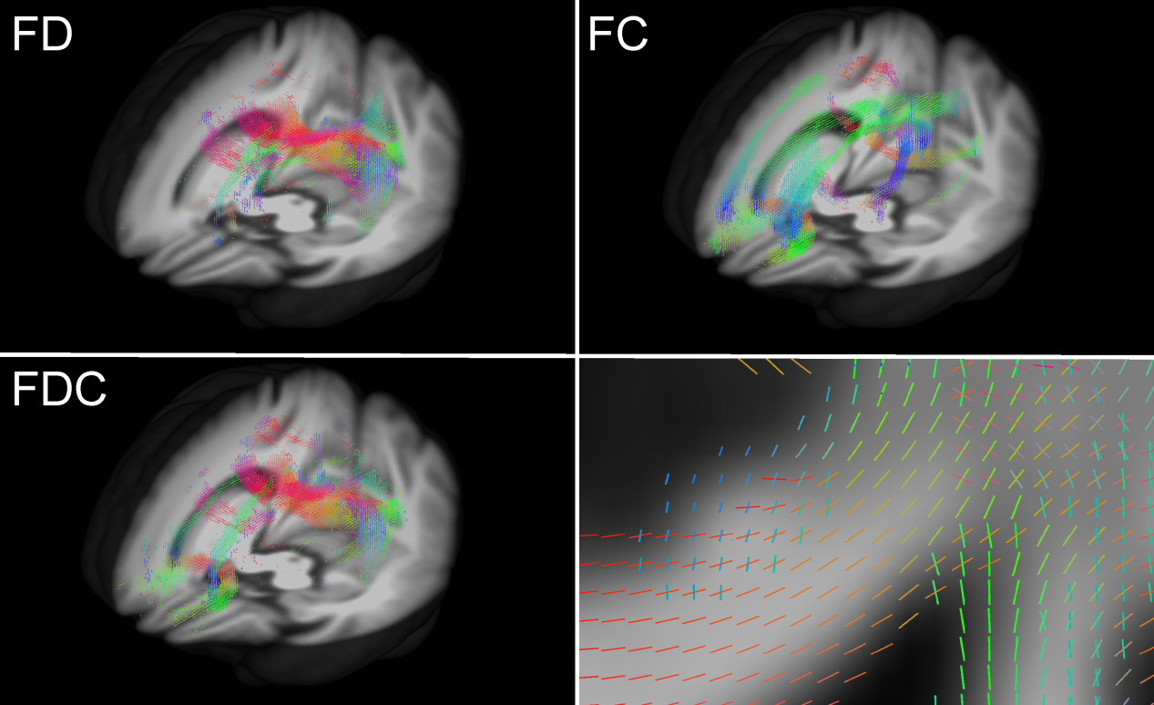 Figure 2. White matter property including splenium of corpus callosum (left) and figer bundles (right) during the course of Parkinson’s Disease.