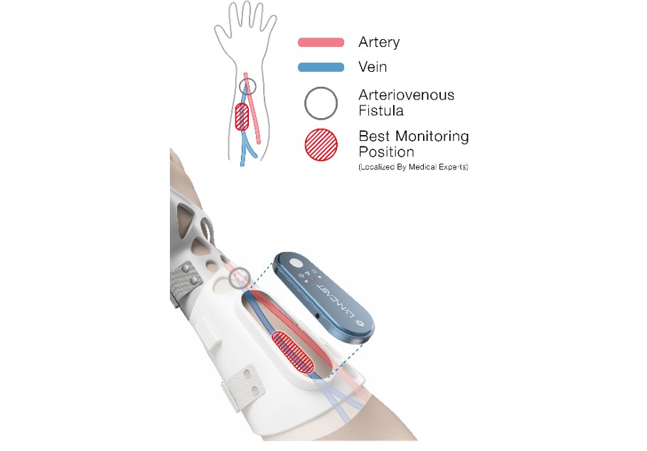 It contains a smart sensor which will be placed at the unique position pre-defined by the technicians for vascular flow detection.