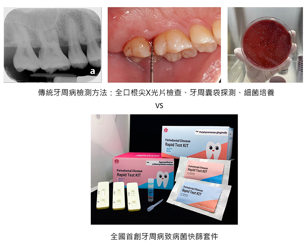 圖三：傳統牙周病檢測方法對比全國首創牙周病致病菌快篩套件